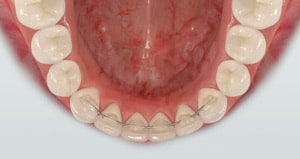 Retainer-upper-clear